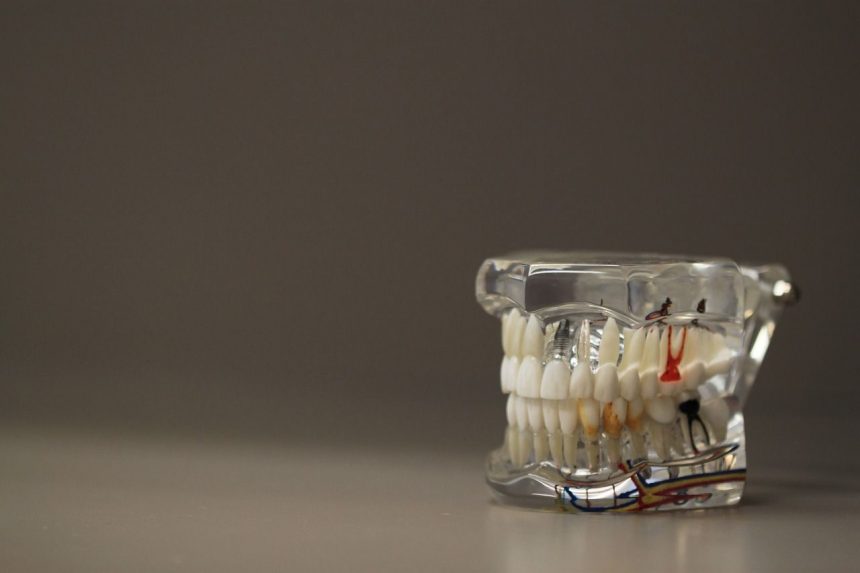Was Sie über Zahnimplantate und Zahnprothesen wissen sollten