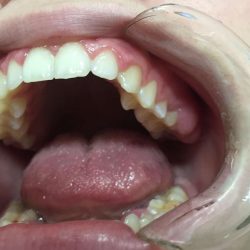 Zahnregulierung in fast jedem Alter möglich